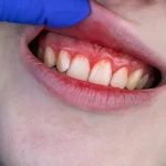 Gum disease may quietly damage the brain, scientists warn